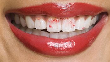 Resultado de imagen para El labial en los dientes. 